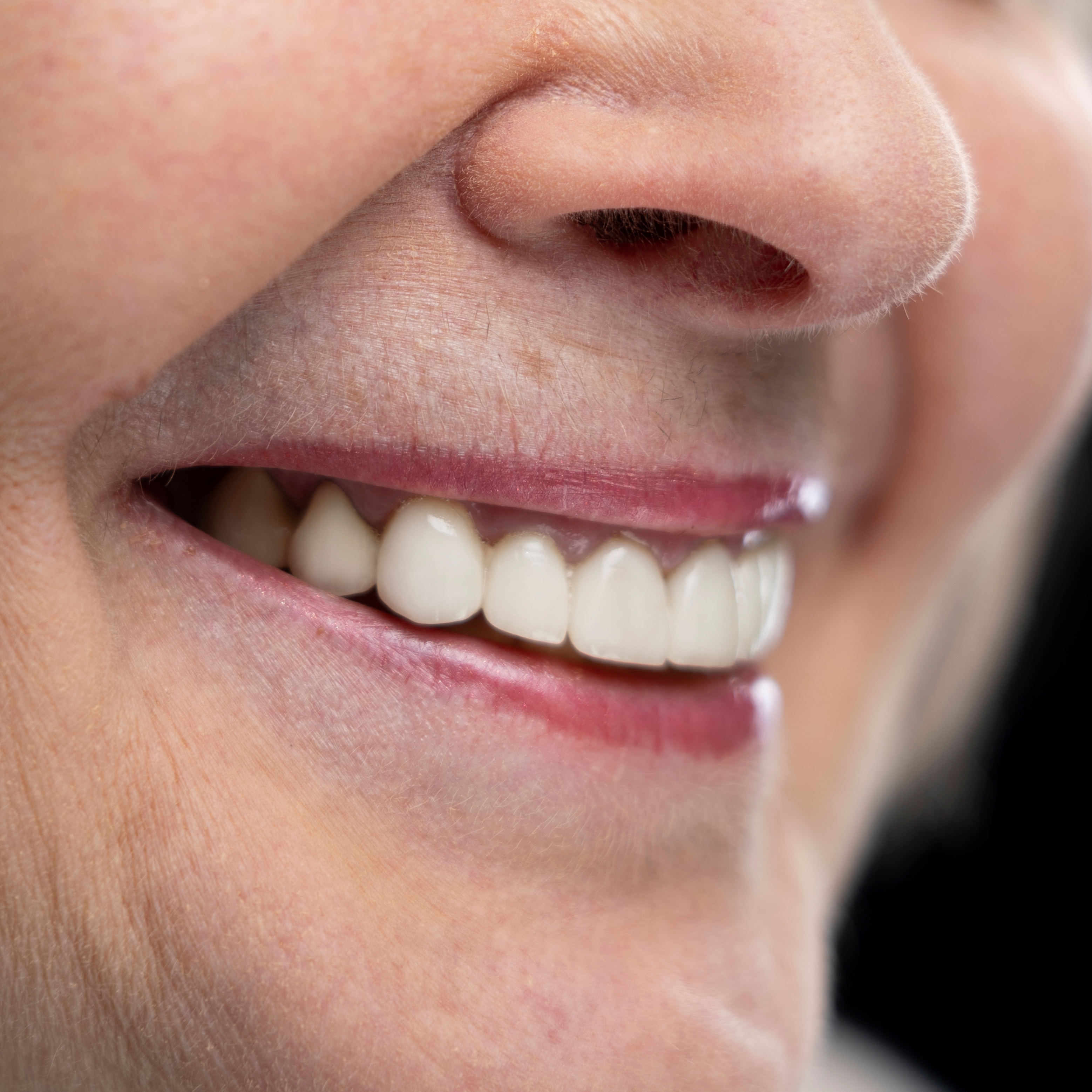 Implante Dentário